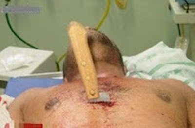 Homem  atendido no PAM  com faca cravada no peito